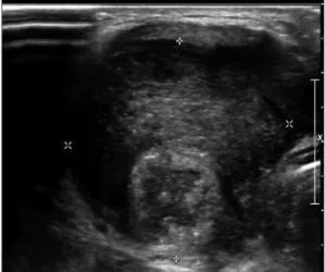 Fig. 2. Preoperative contrast enhanced axial CT section  shows a hypodense lesion with peripheral 