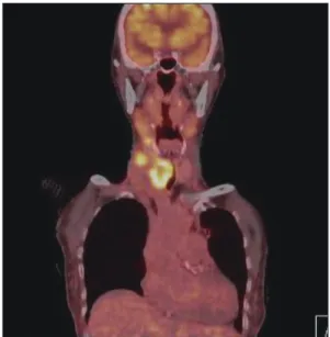 Fig. 6. Postoperative contrast enhanced axial CT section  shows a large recurrent tumor.