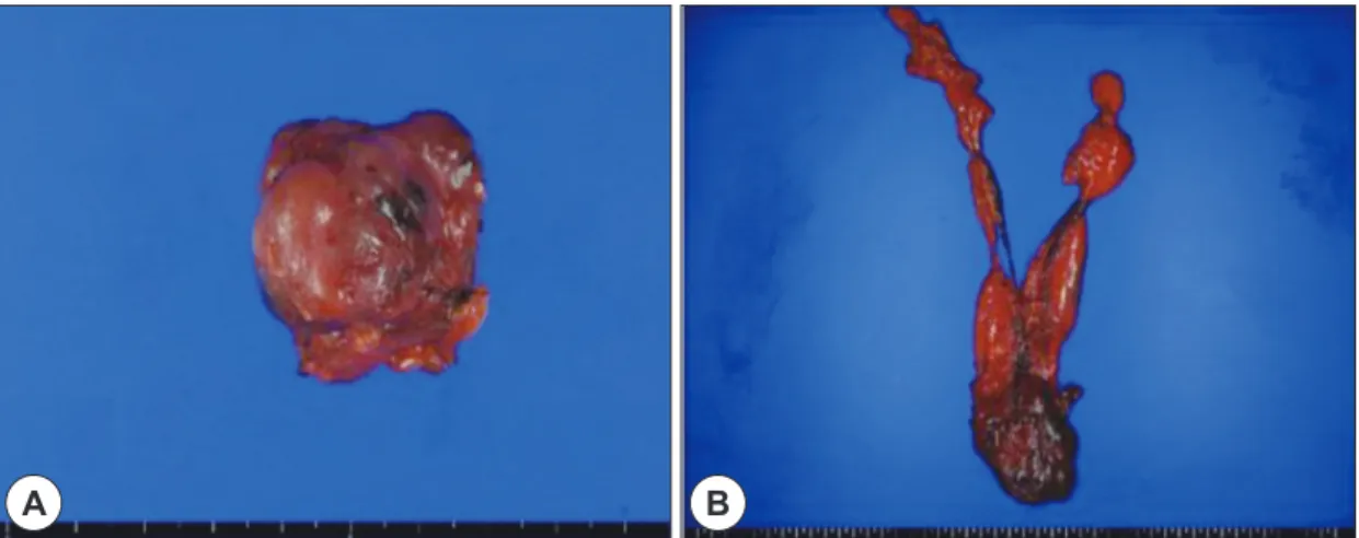 Fig. 3. Histologic findings. Follicles are irregularly enlarged  and aggregated. Variable sized follicles with  hyperplas-tic nodules can be seen (H&amp;E stain, ×40)