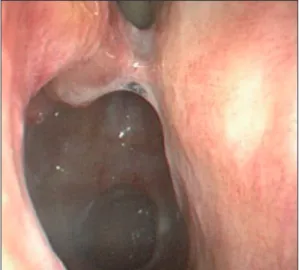 Fig. 5. Postoperative endoscopic finding. The operated  site was healed well without recurrence on 1 year after  surgery.