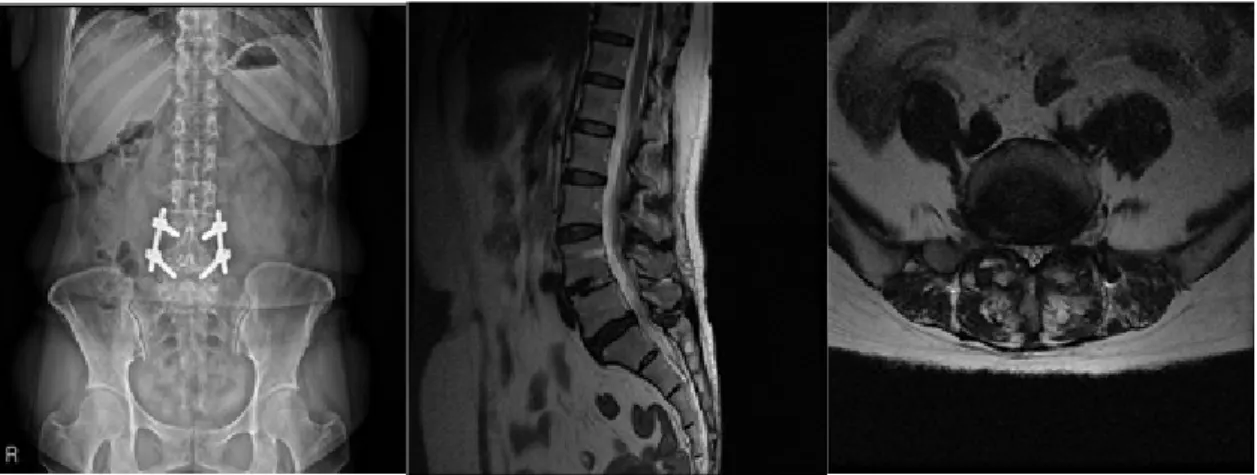 Fig. 2. 2014/03/22, Lumbar x-ray ap, sagittal image, L5-S1 axial image