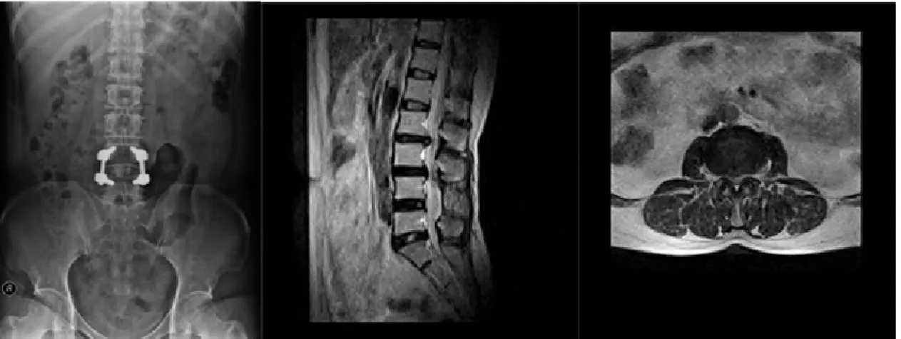 Fig. 3. 2014/02/25, Lumbar x-ray ap, sagittal image, L2-L3 axial image