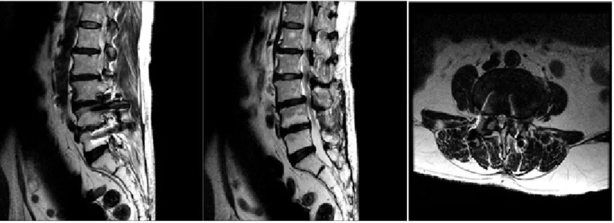 Fig. 4. 2014/02/25, Lumbar MRI sagittal image, L3-L4 axial image
