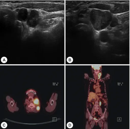 Fig. 1. Size of the level III lymph nodes in the ultrasonograms performed 6 years ago (A) was increased in the ultra- ultra-sonograms performed 3 years ago (B)