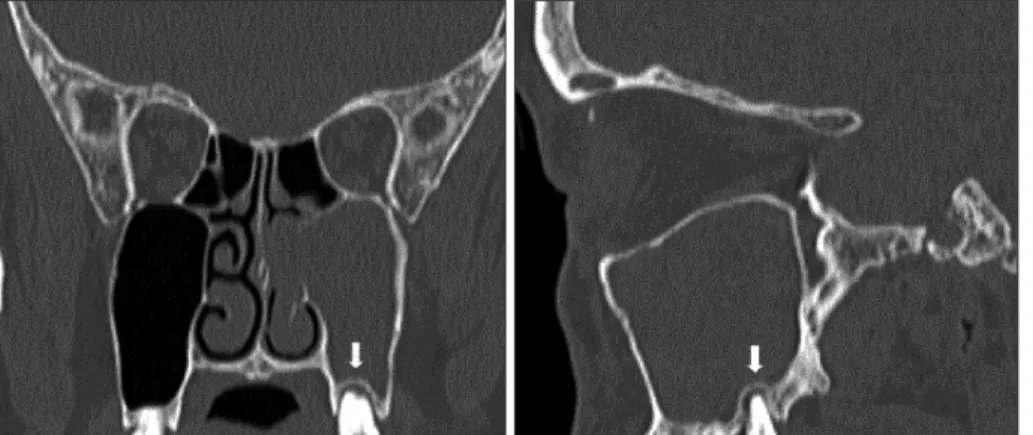 Fig. 1. CT image of periapical lucency. Coronal computed tomography (CT) image (left) and sagittal CT image (right)  show a rounded lucency surrounding a tooth root apex (white arrow).