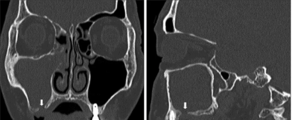 Fig. 3. CT image of uncovered tooth root. Coronal computed tomography (CT) image (right) and sagittal CT image  (left) show a tooth root apex with no osseous partition separating it from the overlying maxillary sinus floor (white arrow).