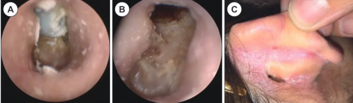 Fig. 1. Preoperative ear findings. Endoscopic findings is a foreign body in the right external auricular canal (A), the  external auricular canal defect after foreign body (hearing aid molding) removal (B), the mastoid cutaneous fistula  at the right posta