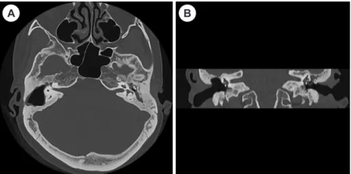 Fig. 3. Axial (A), coronal (B) CT scans is showing the old previous right mastoidectomy state and external ear canal  defect from meato-mastoid to cutaneous.