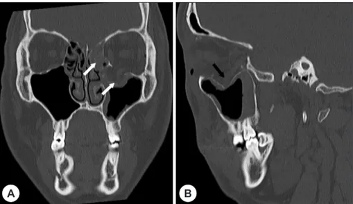 Fig. 1. Pre-operative non-enhanced computed tomography images. Coronal image showing the fractured bony  fragments and soft tissue density (white arrow) in ethmoid &amp; maxillary sinus (A)