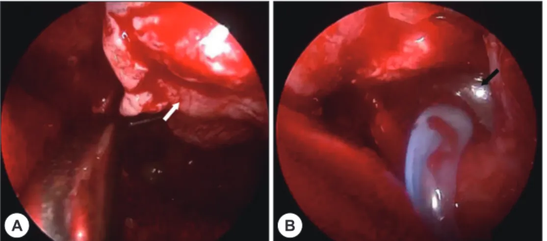Fig. 3. Endoscopic images during transorbital approach. Endoscopic image showing the depressed orbital floor by  catheter deballooning (A)