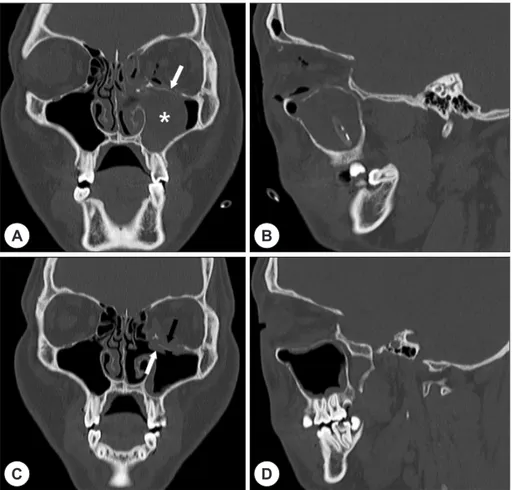 Fig. 4. Post-operative non-enhanced computed tomography images. Upper images are next day after surgery