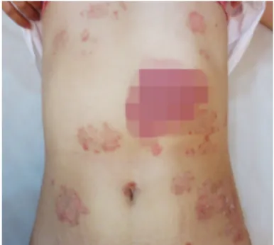 Fig. 1-A. Before treatment:upper lim (2014-11-15)  Fig. 1-B. Before treatment:abdomen (2014-11-15) 