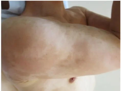 Fig. 6-A. After treatment:upper lim 1 (2015-08-27)  Fig. 6-B. After treatment:upper lim 2 (2015-08-27) 