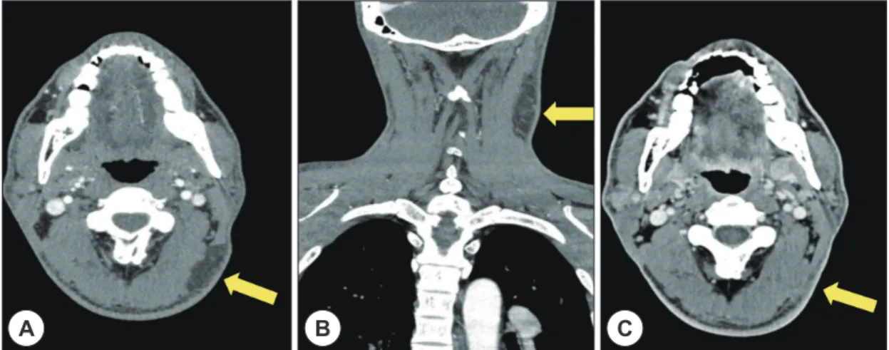 Fig. 1. There is low density mass in the left posterolateral neck under the subcutaneous layer in axial (A), coronal (B)  CT scans, and no mass in post operation CT (C).