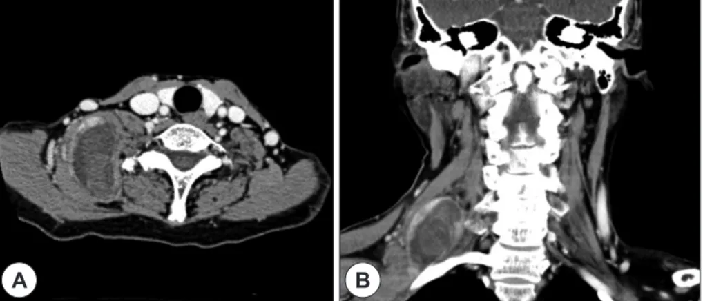 Fig. 2. Axial MRI findings of T1 weighed image (A), T2 weighed image (B) and enhanced T1 weighed image (C) also  shows the 4.0×5.3×6.4 cm sized relatively well defined fusiform mass with peripheral edema.