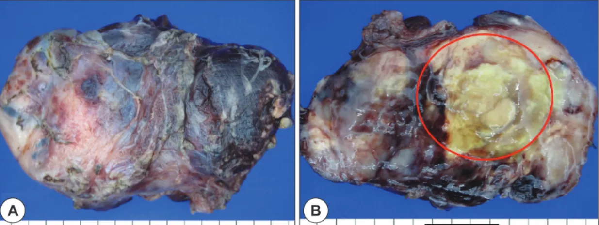 Fig. 3. The specimen was 3.5×5.5×8.0 cm, an ovoid well-encapsulated mass, which was grey-tan color (A)