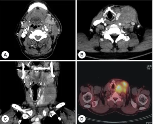 Fig. 1. Computed tomography (CT) and positron emission tomography (PET) images acquired at first visit
