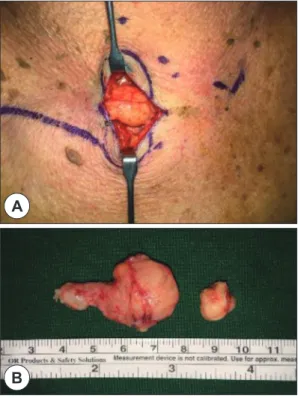 Fig. 2. Gross finding of intra operative excisional biopsy. 