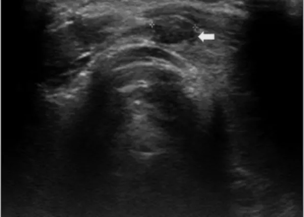 Fig. 2. Axial contrast-enhanced computed tomography scan of neck. A : Ill defined hypodense nodule (arrow) at  the Isthmus