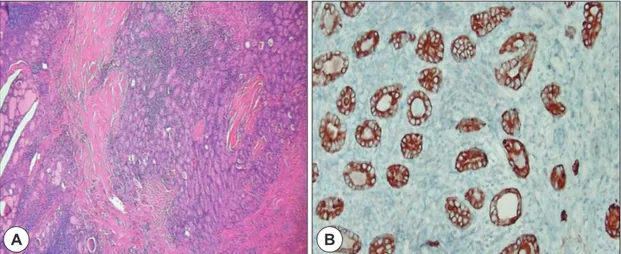 Fig. 4. MALT lymphoma. A : Immunohistochemistry of the biopied tissue shows CD20 positivity (CD20, ×200)
