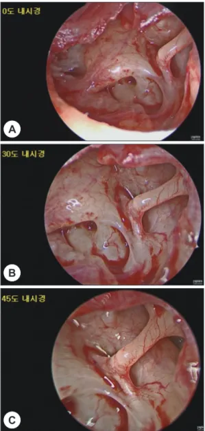 Fig. 1. Wide and clear endoscopic view of the middle 
