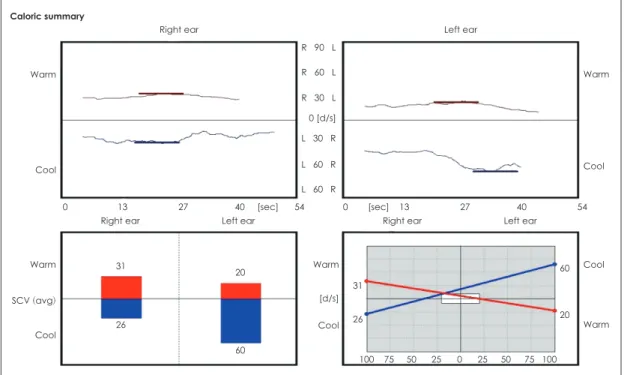 Fig. 3. Caloric test. Canal paresis was within normal range (17%) on caloric test.