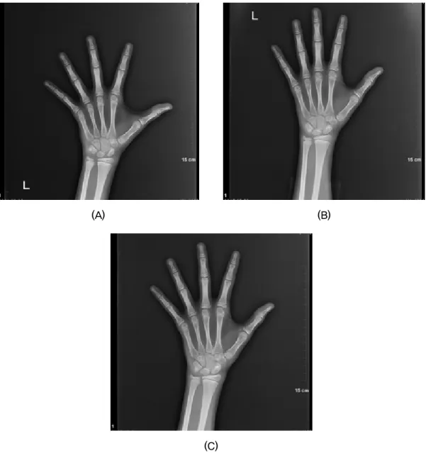 Fig. 1. Radiographs of the left hand were obtained.