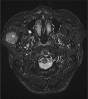 Fig. 2. Macroscopic finding : The tumor is a well circumscribed solid mass with thin fibrous capsule