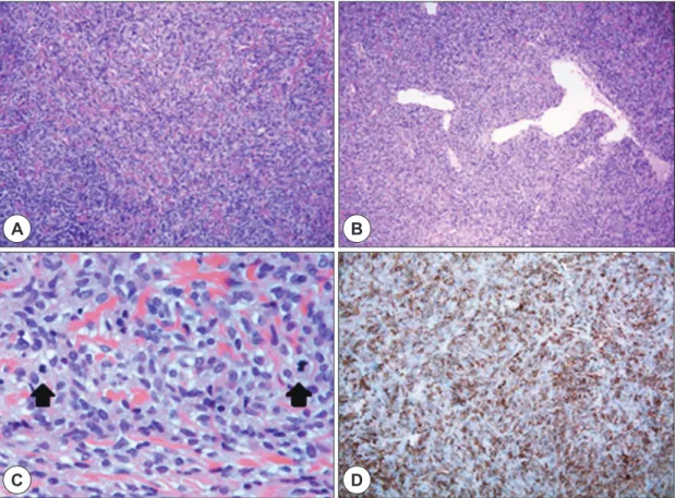Fig. 3. Pathologic findings. A : Spindle cell tumor shows patternless architecture and intercellular deposition of hyalin- hyalin-ized collagen is common