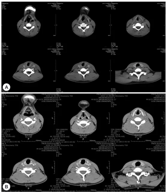 Fig. 1. Images of Neck CT at the time of neck trauma (A) and 6 years after trauma (B)