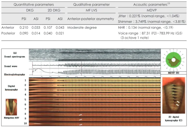 Fig. 2. Sequential images of laryngeal high-speed videoendoscopy (A) and multi-frame laryngeal videostroboscopy  (B) (F 0  : 140 Hz)