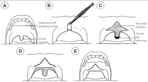 Fig. 1. Surgical techniques of UPF. A, B : Marking of incision line. C : Mucosal excision and uvular tip removal