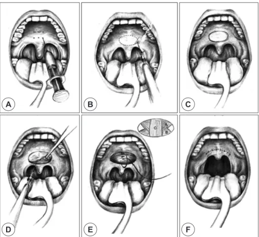 Fig. 2. Surgical techniques of LPMR. A : Local anesthesia. B : Marking of incision line