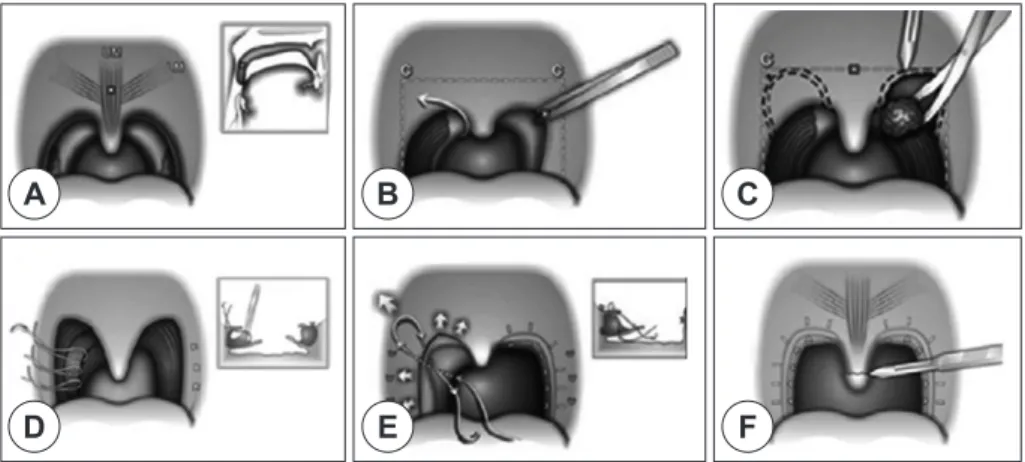 Fig. 5. Surgical techniques of relocation pharyngoplasty. A : Preoperative state. B : Tonsillectomy state and marking  of counter part