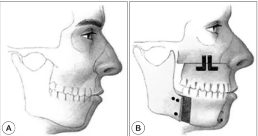 Fig. 8. Maxillomandibular advancement. A : Preoperative state. B : Postoperative state.