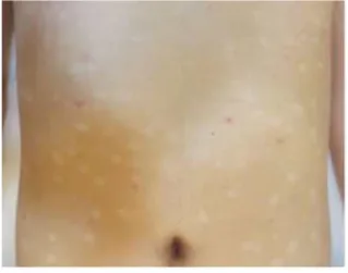 Fig. 4. after 86 days (2014-03-04) Before  Treatment After  18days After  36days After  86days ISI  Score 27 14 7 2