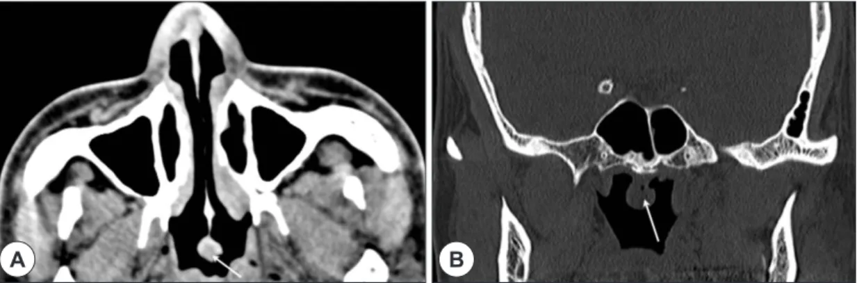 Fig. 2. Axial (A) and coronal images (B) of paranasal sinus CT scans demonstrate 1cm sized pedunculated mass (ar- (ar-row) at posterior end of nasal septum near the junction of the roof of the nasopharynx without bone destruction.