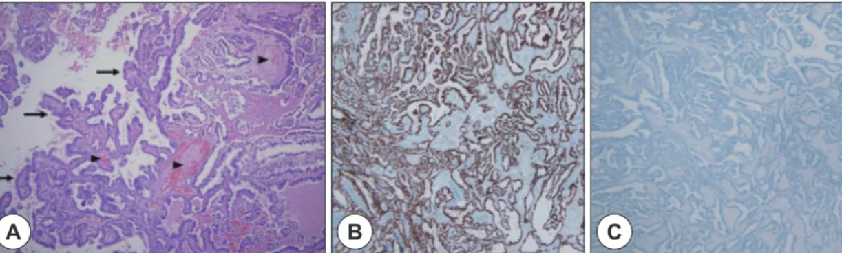 Fig. 4. The tumor shows a papillary growth (arrows) with fibrovascular cores (arrowheads) (H&amp;E stain, ×100) (A)