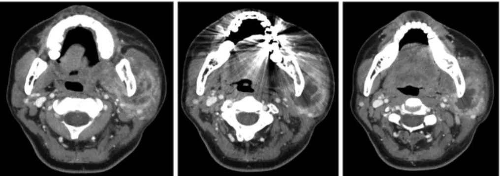 Fig. 2. Axial image of neck CT scan. Increased extent of low-signal intensity area in parotid space, but slightly de- de-creased extent of masticator space, left