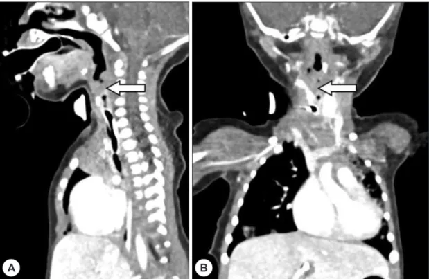 Fig. 4. Laryngoscopic findings 28 days after the EXIT pro- pro-cedure. Glottis was fused while normal supraglottic  struc-tures were identified