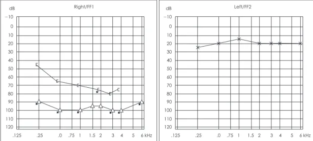 Fig. 4. Nasal endoscopy shows diffuse mucosal swelling  in nasal cavity.