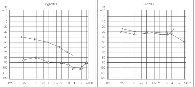 Fig. 6. Follow-up pure tone audiogram shows improved bone conduction hearing.