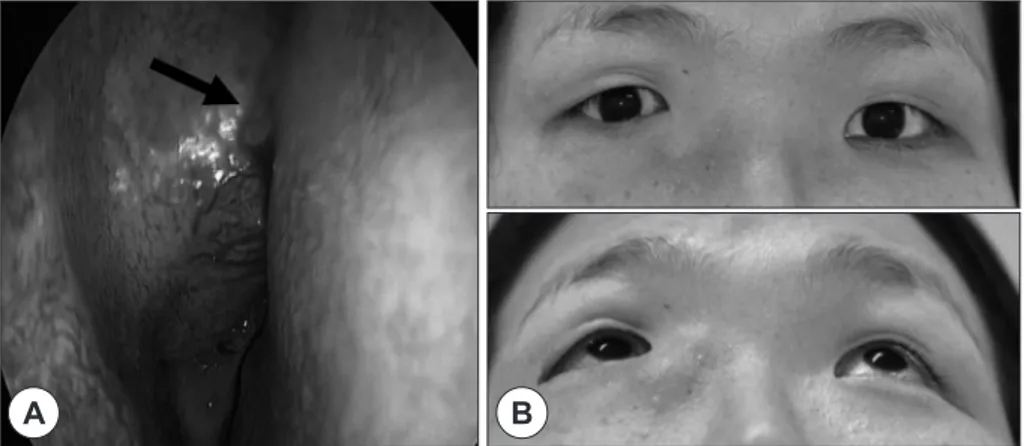 Fig. 1. Preoperative physical findings. The endoscopic examination reveals mass bulging from the lateral wall of the  right nasal cavity (arrow) (A)
