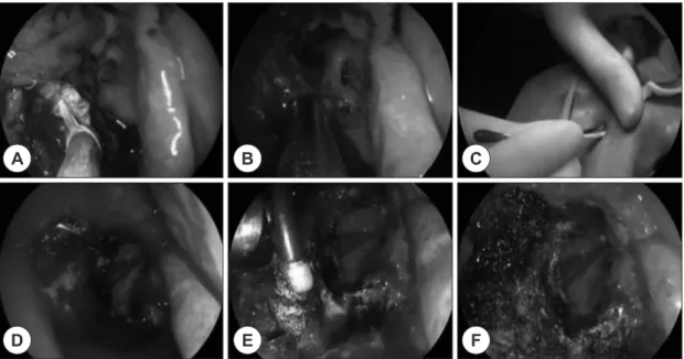 Fig. 4. Intraoperative findings. The ethmoid mass is removed via bipolar coagulation nasal forceps and debrider (be- (be-low approach) (A, B)