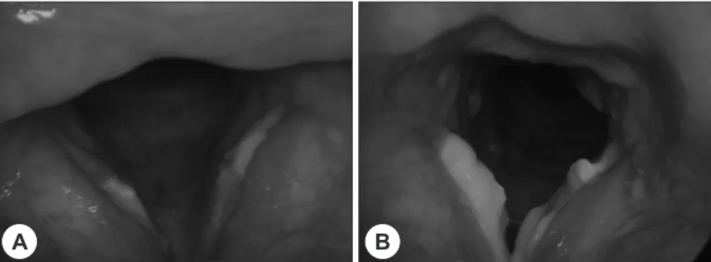 Fig. 3. Stroboscopic view after treatment with itracon- itracon-azole for 3 month : The lesions are completely  disap-peared, and the both vocal cords are slightly  hyper-emic