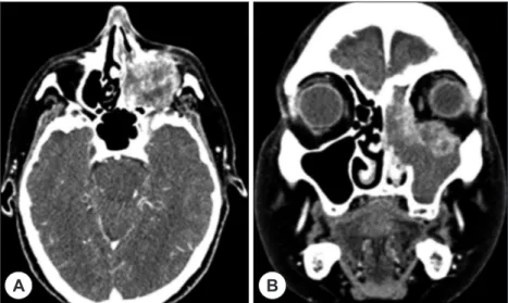 Fig. 1. Radiologic images of preoperative axial (A) and coronal (B) computed tomography scans