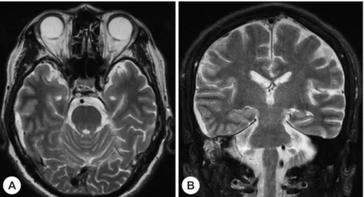 Fig. 2. Axial (A) and coronal (B) T2-weighted magnetic resonance axial images shows high signal intensity suggesting  right subdural abscess (arrow)
