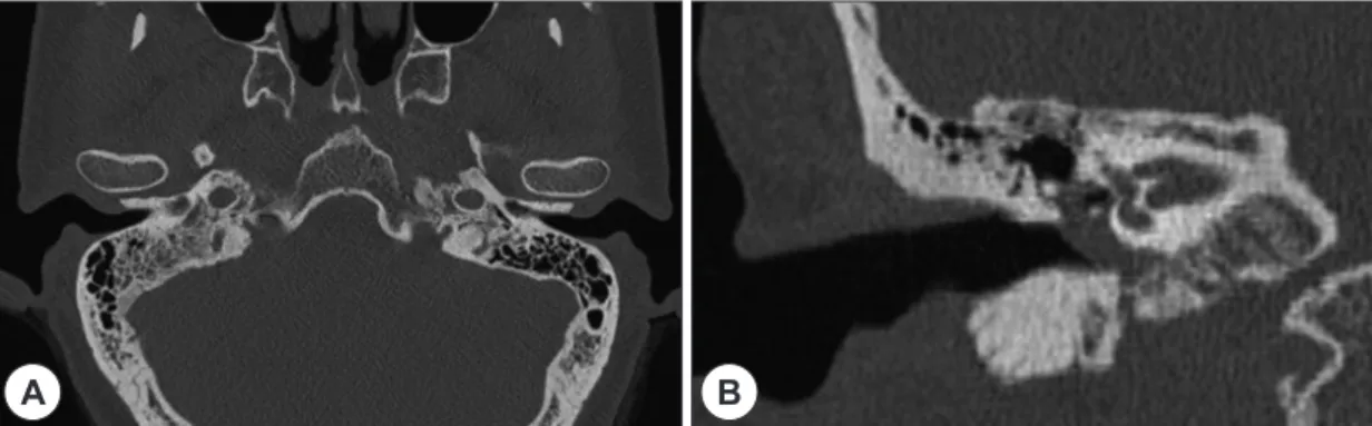 Fig. 3. Histopathologic contents demonstrate sheets and whorls of uniform polygonal cells and some spindle-shaped  cells in H-E stain