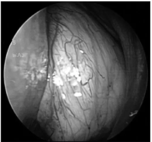 Fig. 2. A : Coronal CT scan shows soft-tissue densities occupying the left frontal, anterior ethmoid, and maxillary sinus