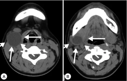 Fig. 1. A : The preoperative neck computed tomography scan showing a cystic mass, 3 cm in diameter, in the right  level II cervical area